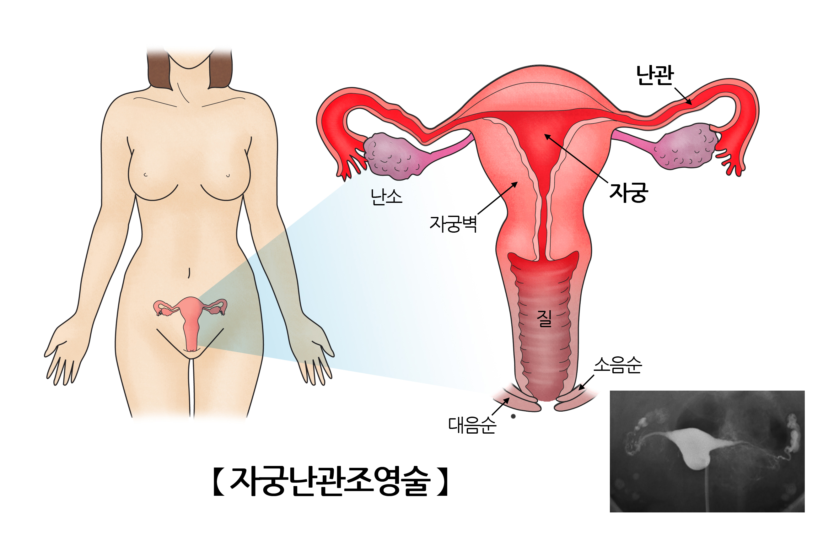 자궁난관조영술