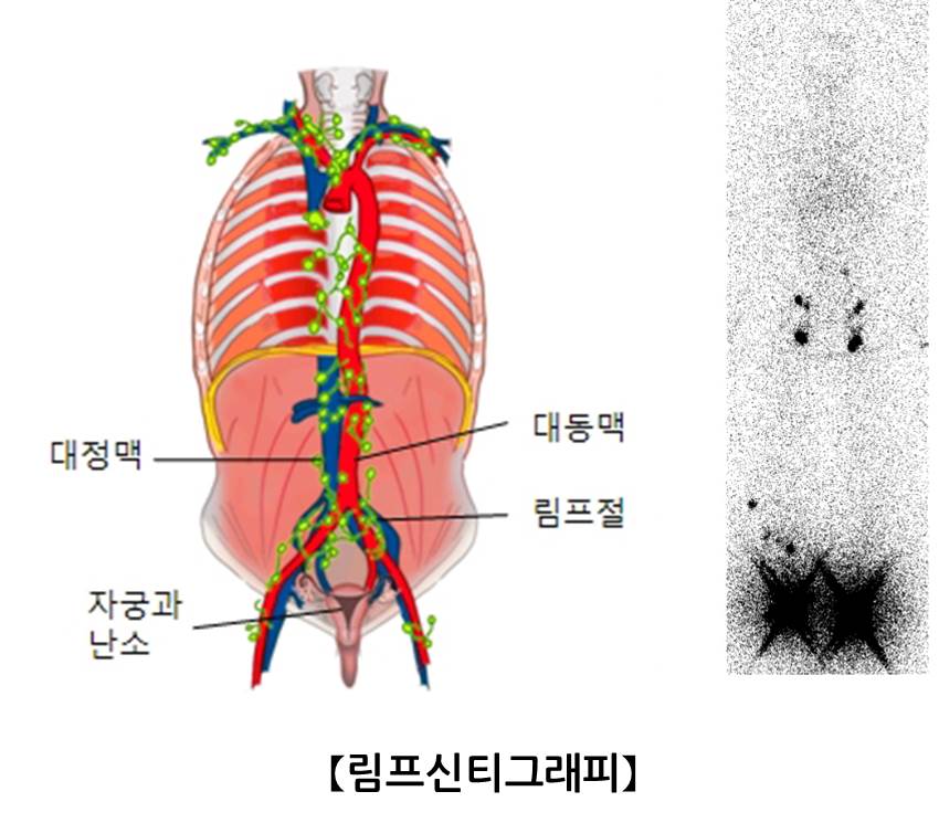 림프관 조영술