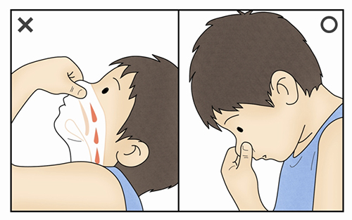 비출혈(Epistaxis) | 질환백과 | 의료정보 | 건강정보 | 서울아산병원